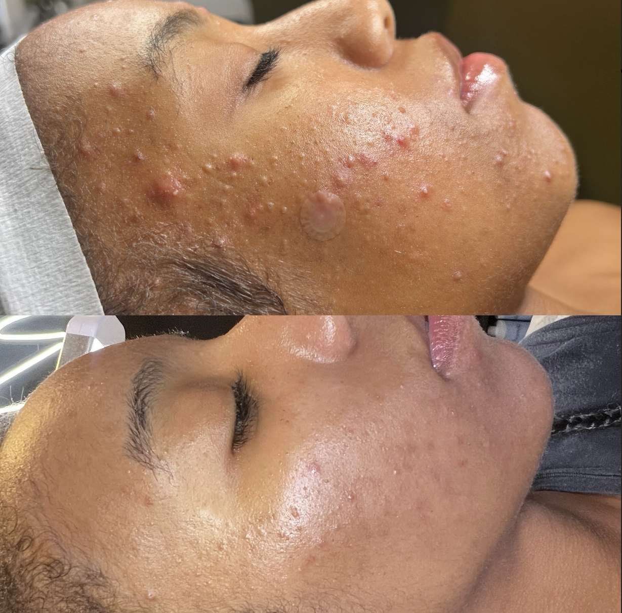 Home Before and After Acne Facial in Los Angeles at Miracle Skin Official