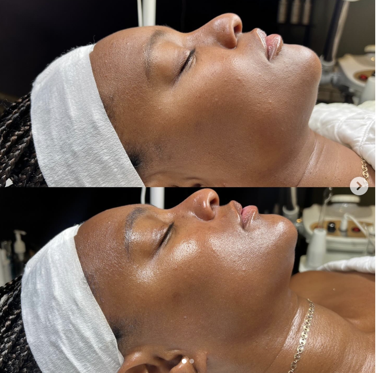 Home Before and After Custom Facial at Miracle Skin Official