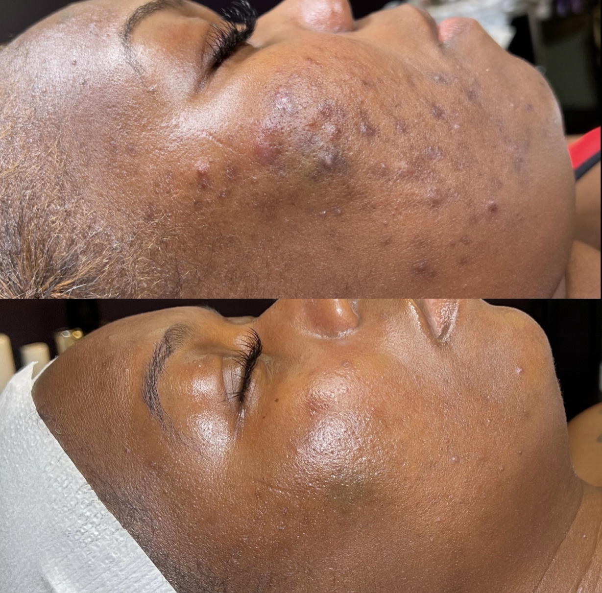 Home Before and After Acne Facial Miracle Skin Official in Los Angeles
