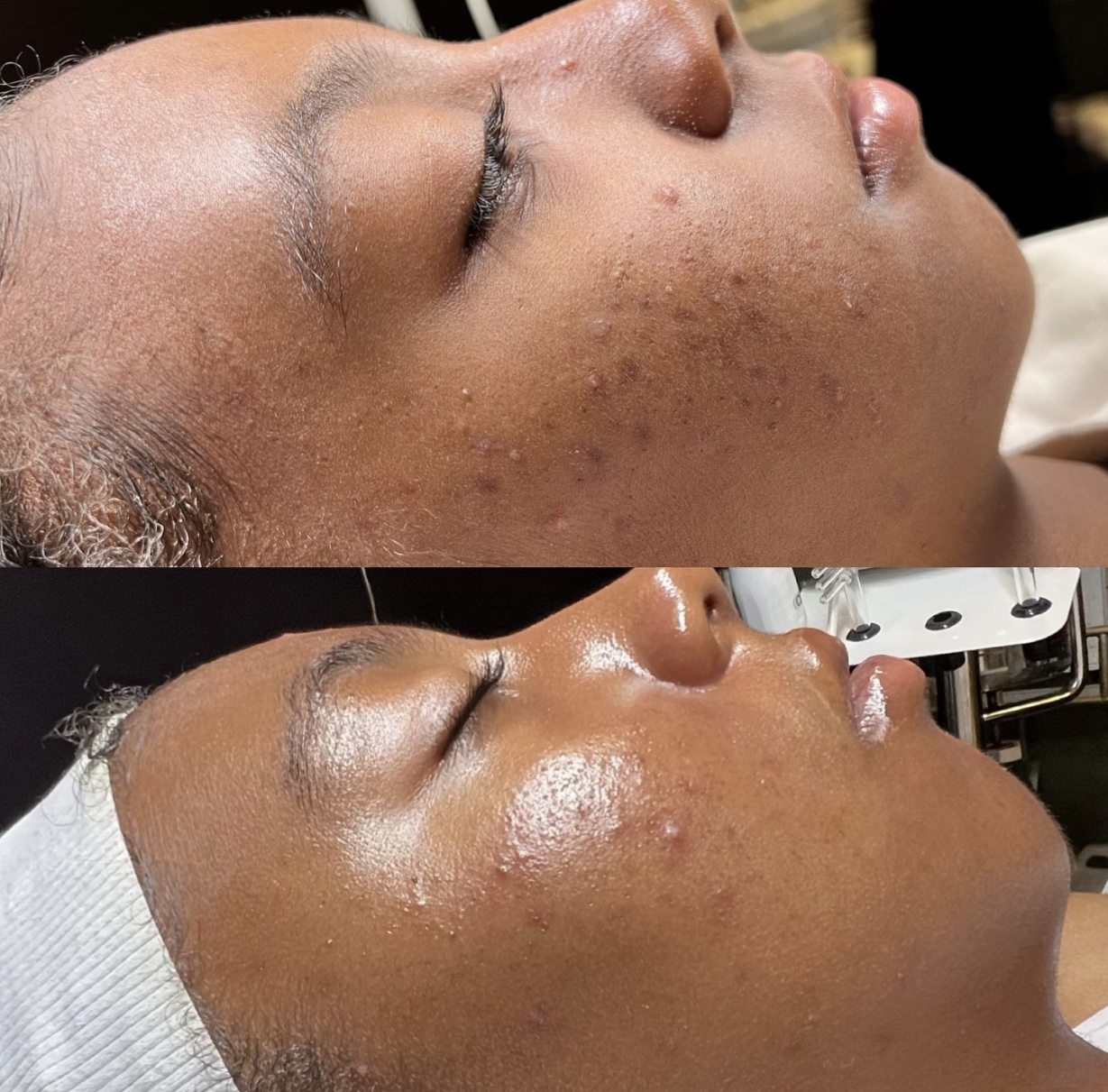 Home Before and After Custom Facial at Miracle Skin Official