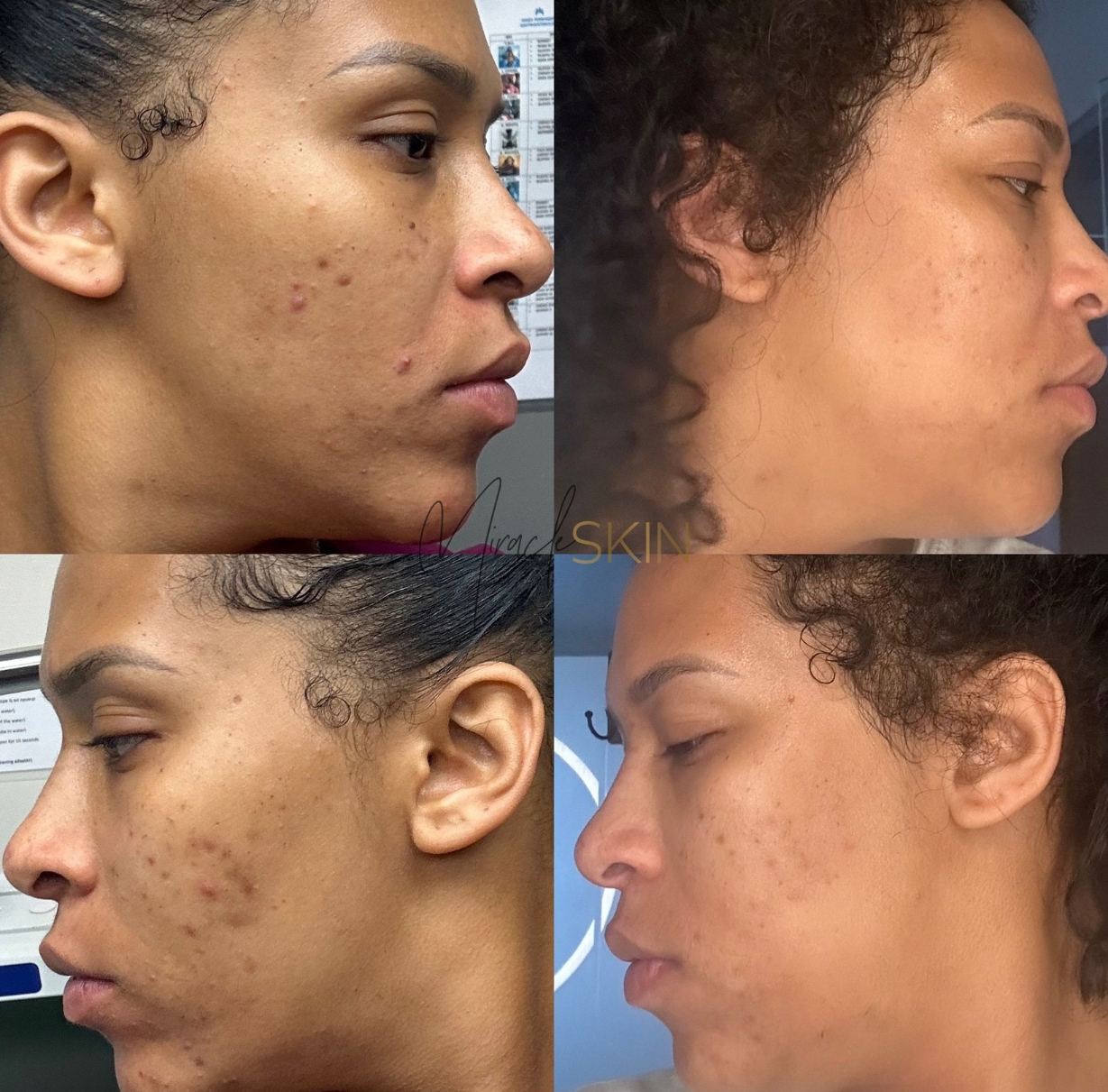 Home Before and After Acne Facial Review at Miracle Skin Official
