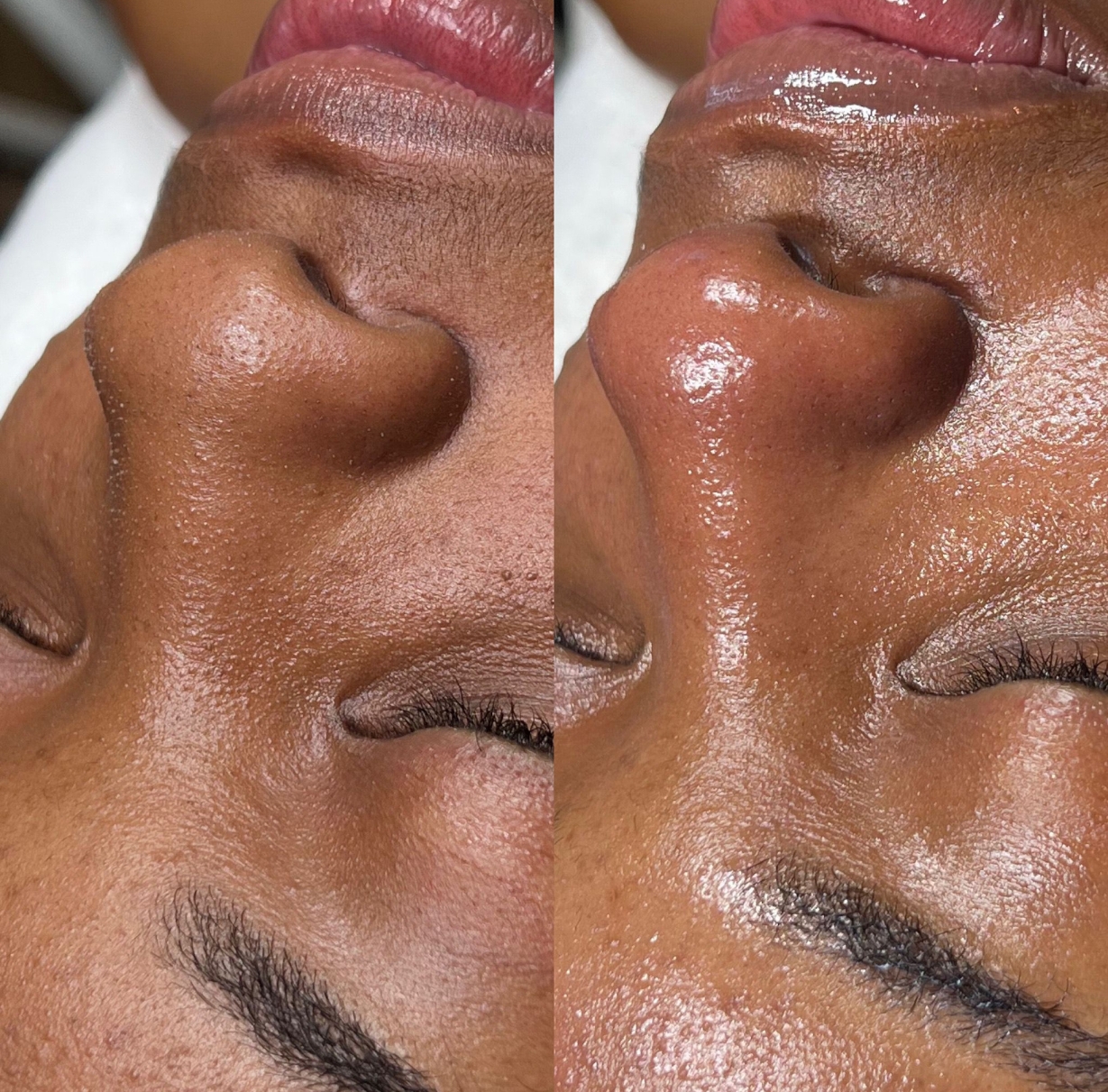 Home Before and After Hydro Glow Facial Review at Miracle Skin Official